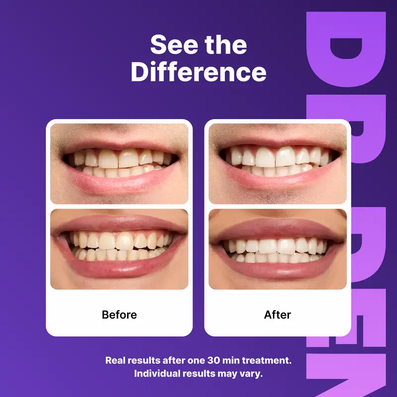Purple Teeth Whitening Strips